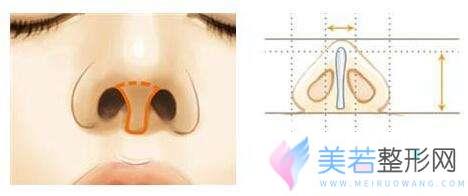 上海闸北区整形医生讲鼻小柱延长手术原理过程
