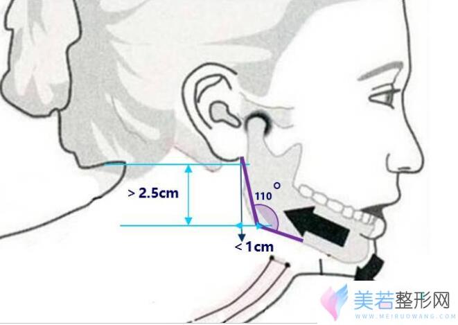 下颌角向下向后突出型