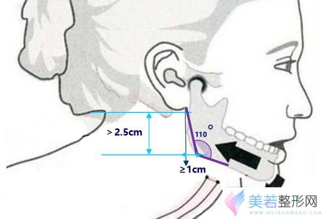 下颌角向下向前突出型