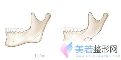磨骨瘦脸并不能单纯切除下颌角就行的