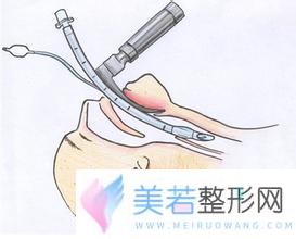 削骨没问题还是磨骨没问题