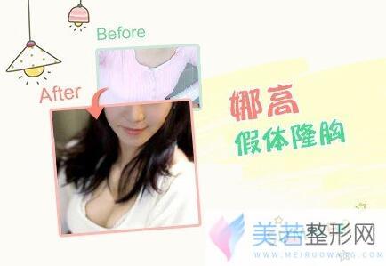 娜高假体丰胸果如何？来看看果图~