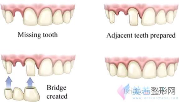 美齿冠是什么？美齿冠果好吗？