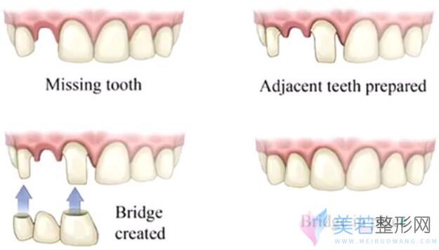 美齿冠后应怎样护理牙齿，你也可以拥有明星般美丽~