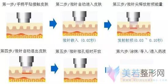 微针去痘坑后泛红、反黑，微针去痘坑会让人“烂脸”吗？