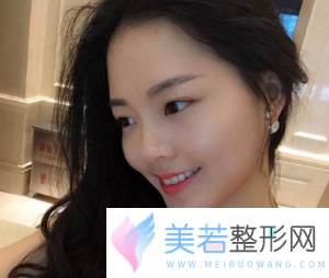 上海九院凸嘴手术_手术恢复过程图_真人案例果_2019凸嘴整形价格