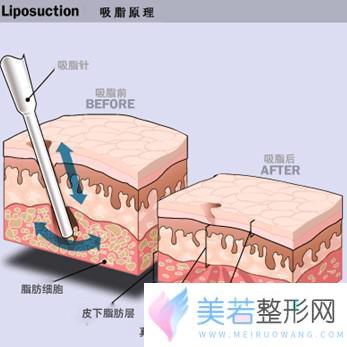 吸脂减肥原理