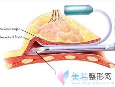 内窥镜假体隆胸需要多少钱 内窥镜隆胸手术的果图