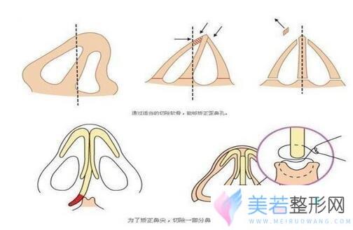 自体耳软骨隆鼻价格 自体软骨隆鼻整形手术果如何