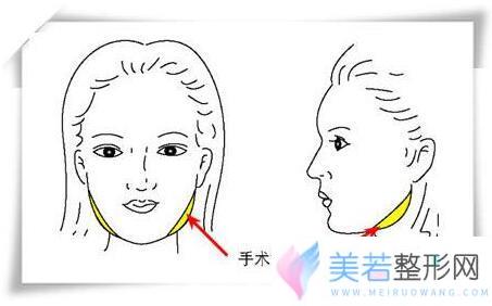 重庆叶子整形医院价格表一览