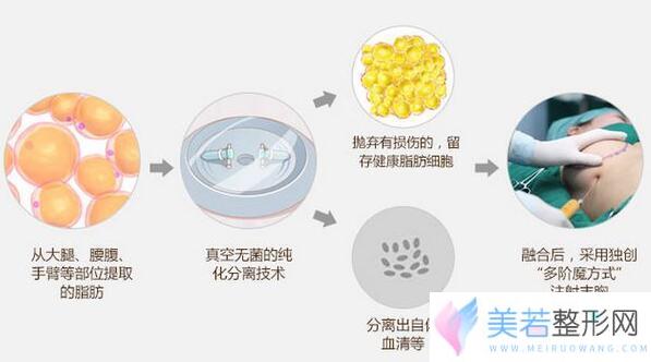 广州自体脂肪丰胸价格表出炉辣