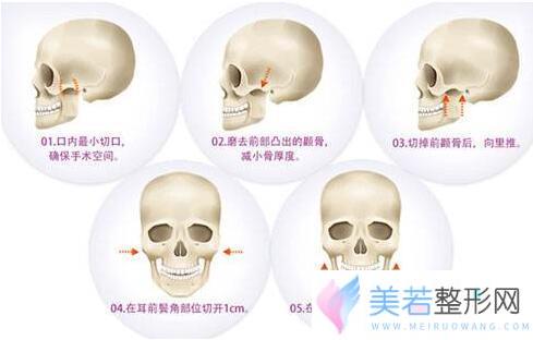 北京颧骨内推价格表全新爆出