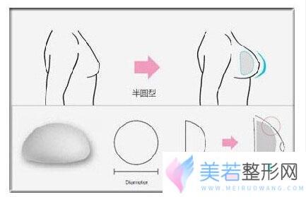 合肥假体隆胸收费多少钱