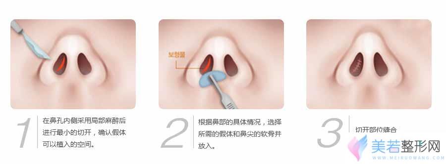 郑州华山整形医院整形价格表全新预览