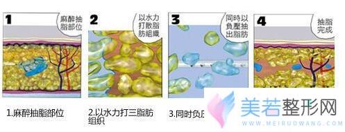 水动力吸脂图解