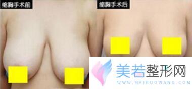 广东深圳巨乳缩小术价格是多少，巨乳缩小前后对比图