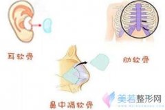 成都医院做鼻中隔软骨隆鼻大约需要多少钱？不想去外地做~