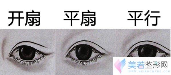 平扇和开扇双眼皮果图