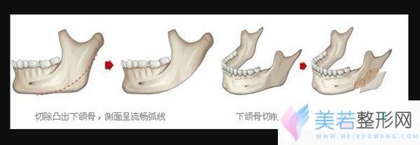下颌角整形示意图
