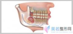 拔智齿真的会让脸小吗？拔完智齿还用做下颌角整形吗？