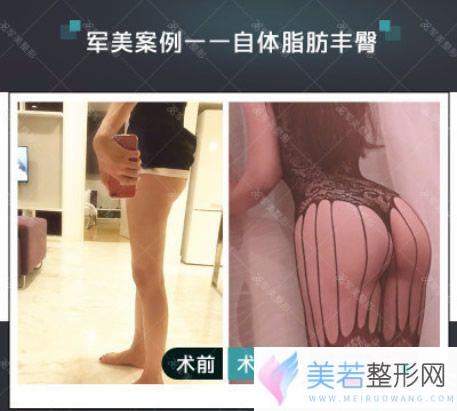 广州军美真人腰腹吸脂和自体脂肪丰臀果案例