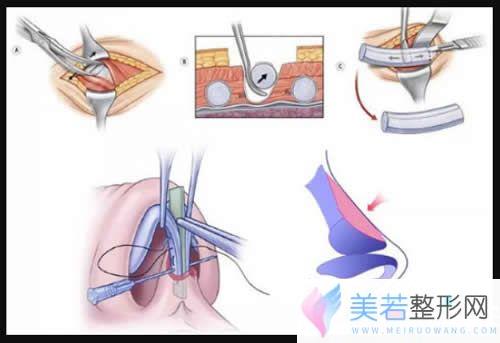 肋软骨隆鼻示意图