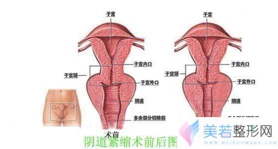 阴道紧缩术前后对比