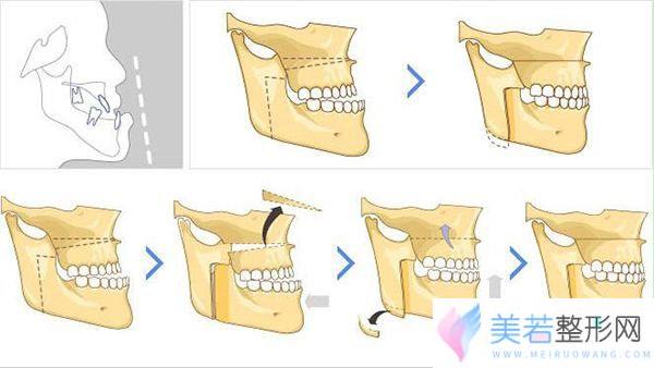 面部双鄂手术