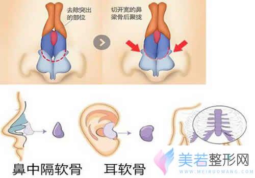 软骨矫正驼峰鼻示意图