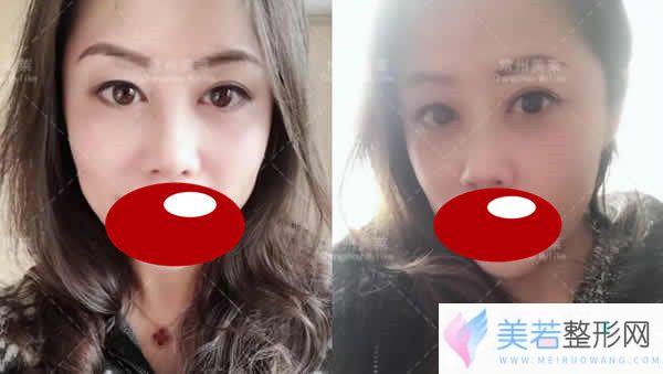 在常州美莱找李志勇医生为我做面部埋线提升术后果图