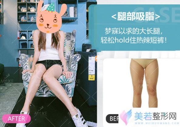 袁玉坤大腿吸脂果怎么样