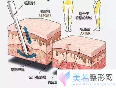 吸脂手术原理