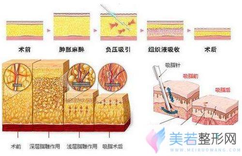 吸脂手术过程介绍