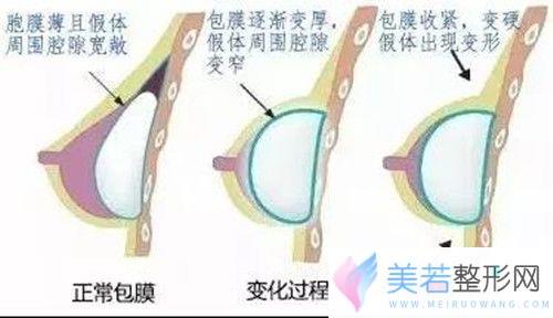 包膜挛缩