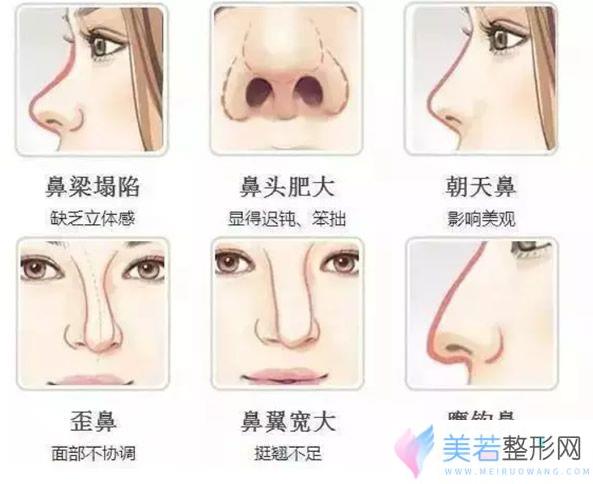 隆鼻能改良的鼻子症状