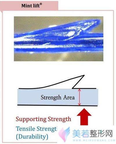 韩国纯真埋线提升采用MINT线
