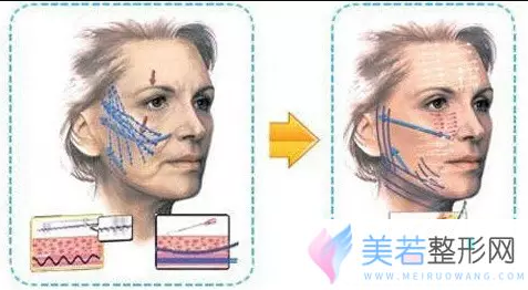 埋线提升术提拉下垂面部