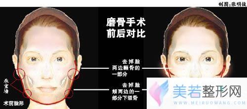 磨骨手术前后对比图