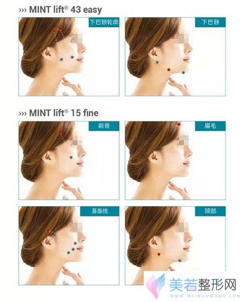 MINT线适用于面部各个部位