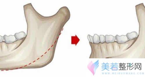 磨骨后遗症介绍