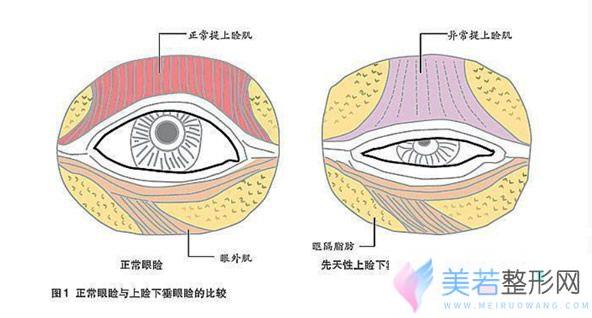 上睑下垂与正常眼睛的区别