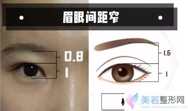 眉眼间距窄和标准值示意图