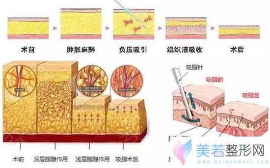 做吸脂前后对比果图