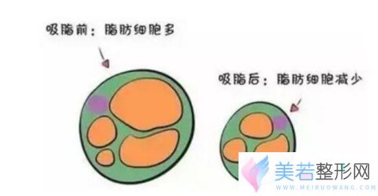 抽脂手术原理介绍