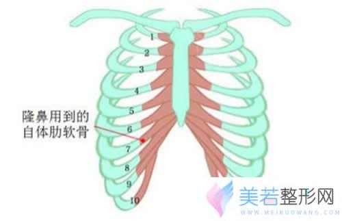 千万不要自体肋骨隆鼻的真相揭秘