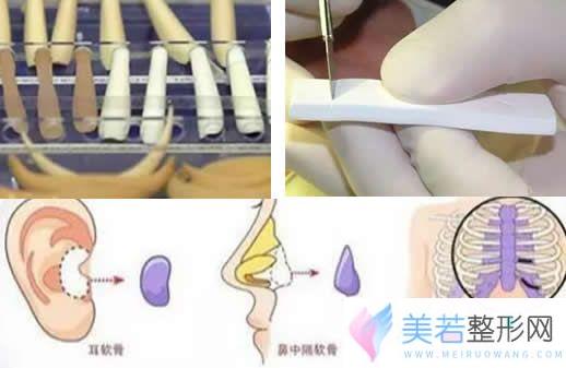 硅胶、膨体、自体软骨隆鼻材料区别对比