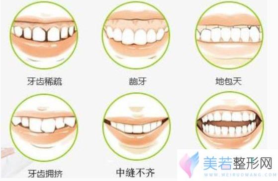 哪些牙齿需要矫正