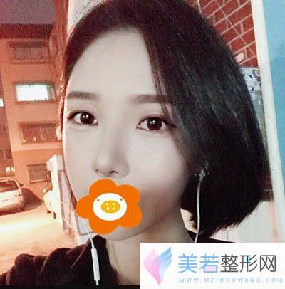 做眼睛鼻子术后20天还有点肿果图