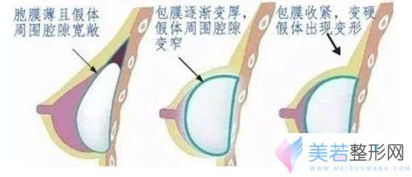 假体隆胸后包膜挛缩发展过程