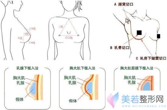 假体隆胸的切口和植入方式